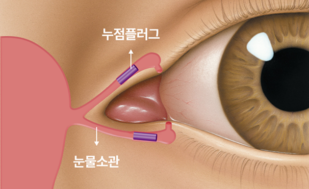 누점폐쇄술