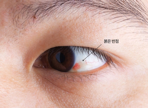 결막하출혈 주요 증상