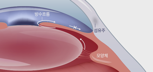 만성(개방각)녹내장