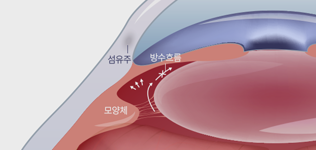 급성(폐쇄각)녹내장
